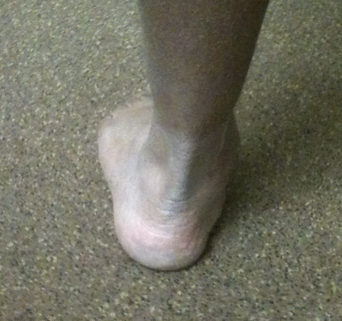 Valgus Hindfoot Clinical